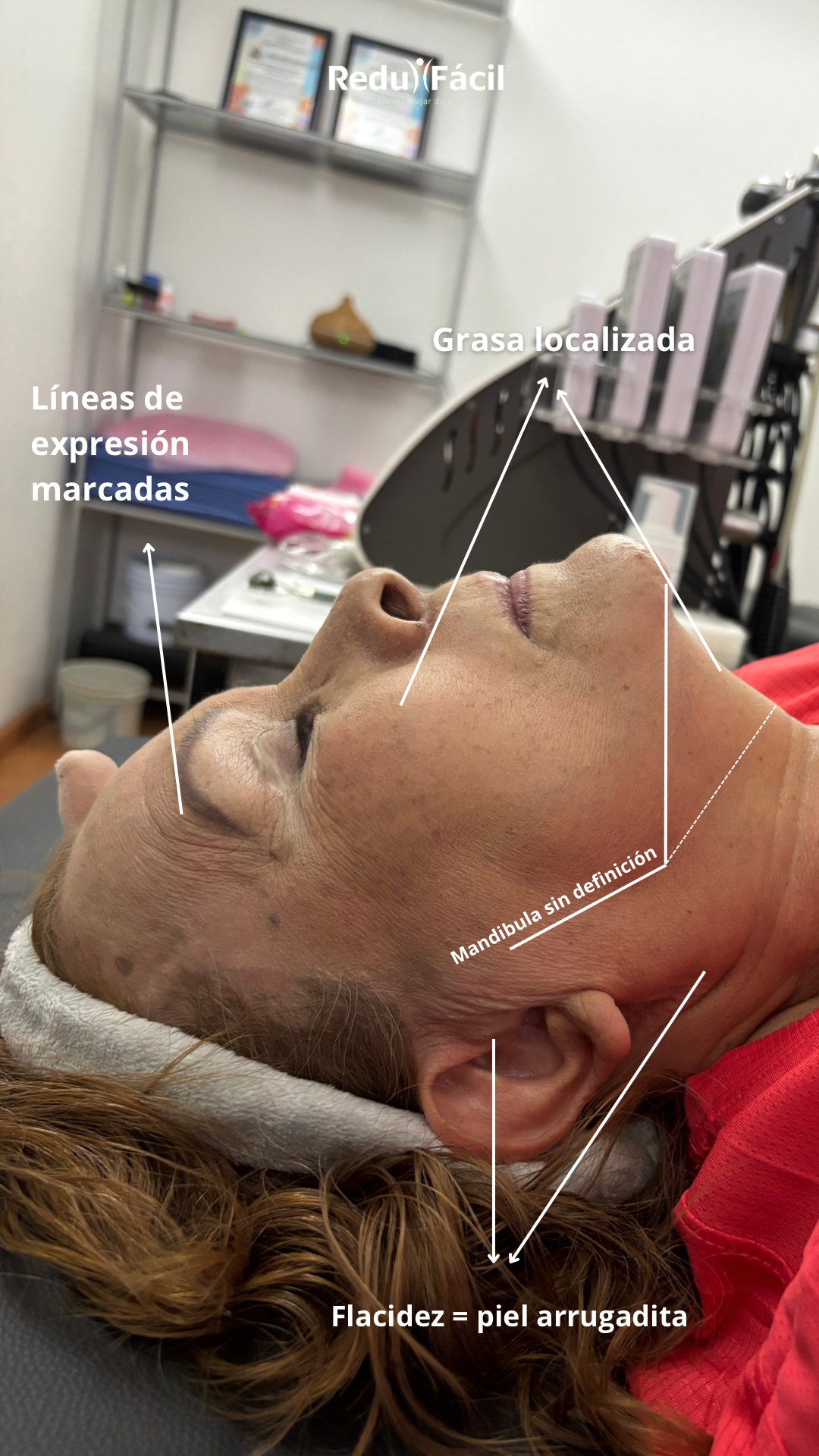 Faciales de Radiofrecuencia