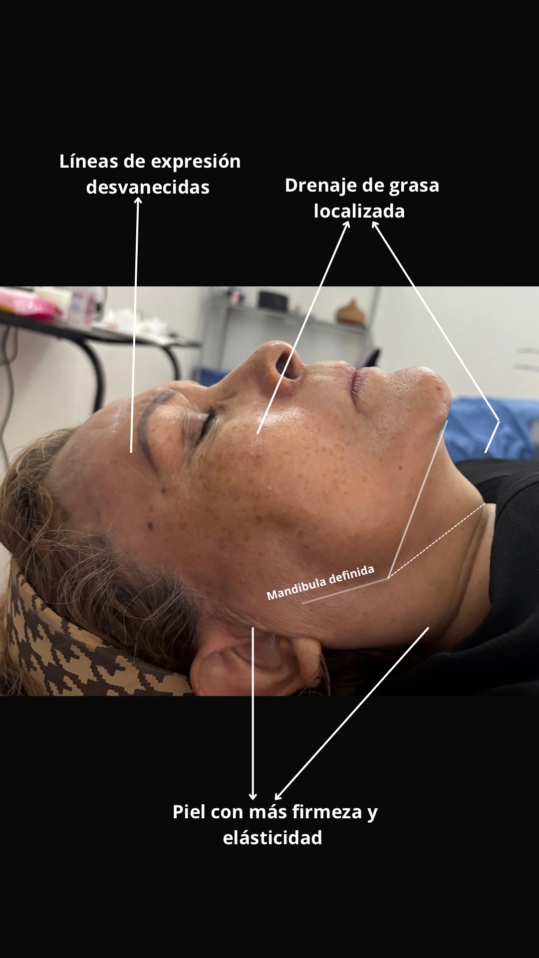 Faciales de Radiofrecuencia