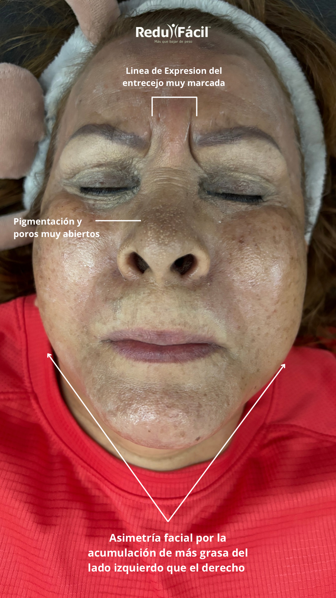 Faciales de Radiofrecuencia