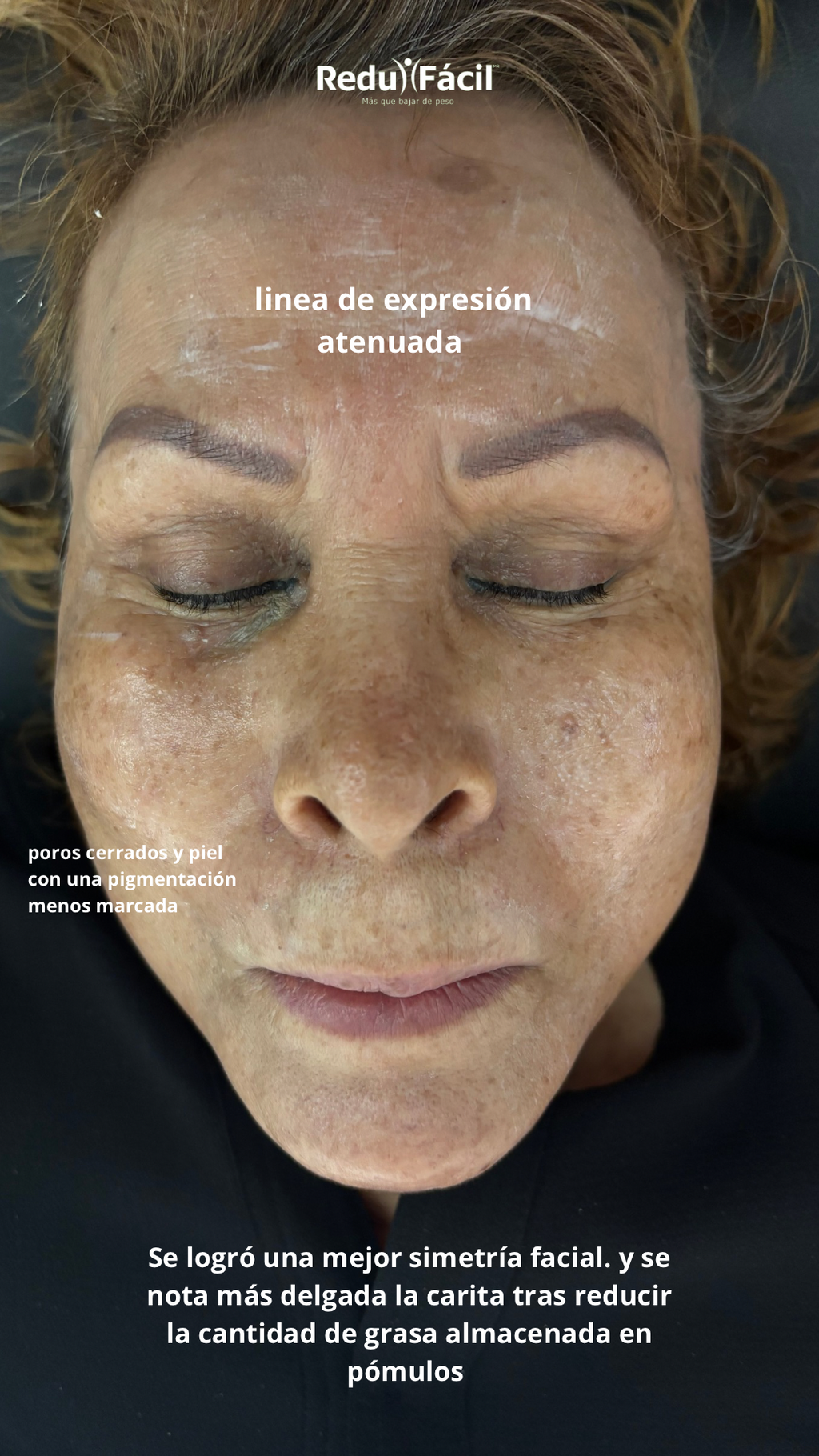 Faciales de Radiofrecuencia